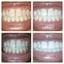 Skavix | Extra-Strength Teeth Whitening Pen